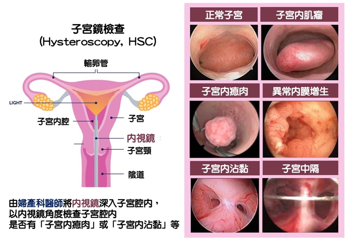 子宮鏡檢查